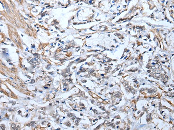 STRADA / LYK5 Antibody - Immunohistochemistry of paraffin-embedded Human gastric cancer tissue  using STRADA Polyclonal Antibody at dilution of 1:45(×200)