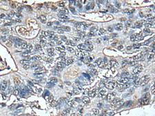 STRADA / LYK5 Antibody - Immunohistochemistry of paraffin-embedded Human colorectal cancer tissue  using STRADA Polyclonal Antibody at dilution of 1:85(×200)