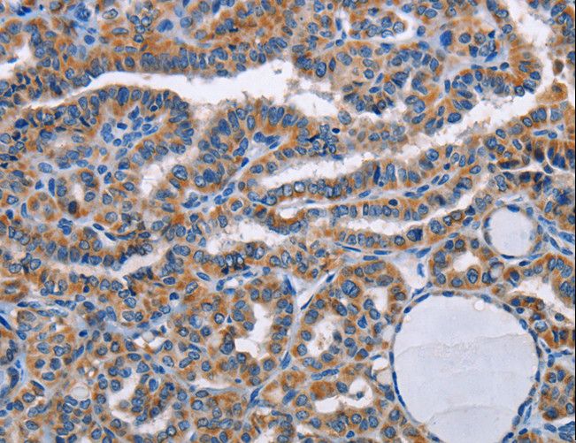 STRADB / ALS2CR2 Antibody - Immunohistochemistry of paraffin-embedded Human thyroid cancer using STRADB Polyclonal Antibody at dilution of 1:20.