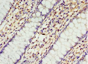 STRAP / MAWD Antibody - Immunohistochemistry of paraffin-embedded human colon cancer using antibody at 1:100 dilution.