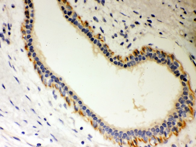 STRAP / MAWD Antibody - Unrip antibody IHC-paraffin: Human Mammary Cancer Tissue.