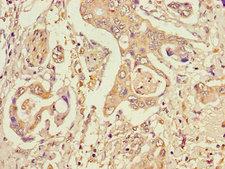 STT3A / ITM1 Antibody - Immunohistochemistry of paraffin-embedded human pancreatic cancer using STT3A Antibody at dilution of 1:100