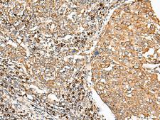 STT3A / ITM1 Antibody - Immunohistochemistry of paraffin-embedded Human cervical cancer tissue  using STT3A Polyclonal Antibody at dilution of 1:70(×200)