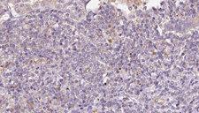 STT3B Antibody - 1:100 staining human lymph carcinoma tissue by IHC-P. The sample was formaldehyde fixed and a heat mediated antigen retrieval step in citrate buffer was performed. The sample was then blocked and incubated with the antibody for 1.5 hours at 22°C. An HRP conjugated goat anti-rabbit antibody was used as the secondary.