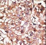 STUB1 / CHIP Antibody - Formalin-fixed and paraffin-embedded human cancer tissue reacted with the primary antibody, which was peroxidase-conjugated to the secondary antibody, followed by AEC staining. This data demonstrates the use of this antibody for immunohistochemistry; clinical relevance has not been evaluated. BC = breast carcinoma; HC = hepatocarcinoma.