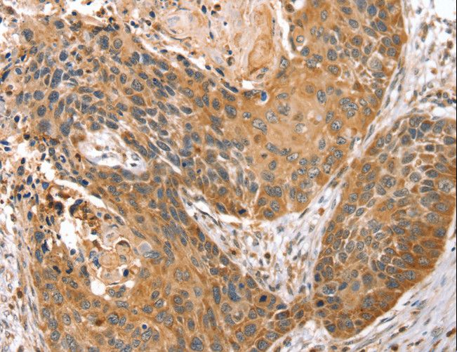 STX10 / Syntaxin 10 Antibody - Immunohistochemistry of paraffin-embedded Human esophagus cancer using STX10 Polyclonal Antibody at dilution of 1:45.