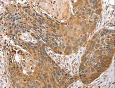 STX10 / Syntaxin 10 Antibody - Immunohistochemistry of paraffin-embedded Human esophagus cancer using STX10 Polyclonal Antibody at dilution of 1:45.