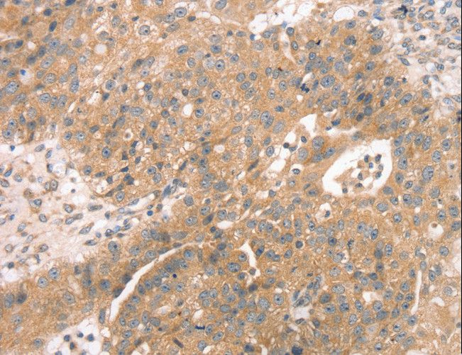 STX10 / Syntaxin 10 Antibody - Immunohistochemistry of paraffin-embedded Human breast cancer using STX10 Polyclonal Antibody at dilution of 1:45.