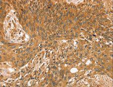STX10 / Syntaxin 10 Antibody - Immunohistochemistry of paraffin-embedded Human esophagus cancer using STX10 Polyclonal Antibody at dilution of 1:35.