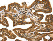 STX11 / Syntaxin 11 Antibody - Immunohistochemistry of paraffin-embedded Human thyroid cancer using STX11 Polyclonal Antibody at dilution of 1:30.