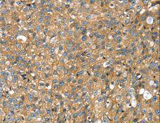 STX11 / Syntaxin 11 Antibody - Immunohistochemistry of paraffin-embedded Human breast cancer using STX11 Polyclonal Antibody at dilution of 1:30.