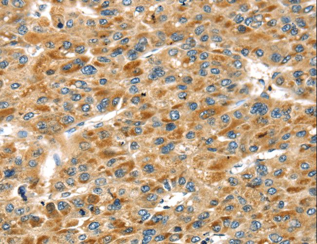STX11 / Syntaxin 11 Antibody - Immunohistochemistry of paraffin-embedded Human liver cancer using STX11 Polyclonal Antibody at dilution of 1:30.