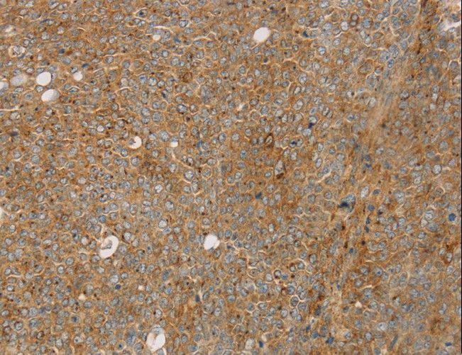 STX16 / Syntaxin 16 Antibody - Immunohistochemistry of paraffin-embedded Human ovarian cancer using STX16 Polyclonal Antibody at dilution of 1:30.