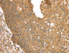 STX16 / Syntaxin 16 Antibody - Immunohistochemistry of paraffin-embedded Human esophagus cancer using STX16 Polyclonal Antibody at dilution of 1:30.