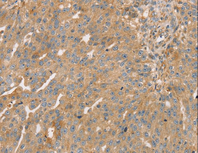 STX16 / Syntaxin 16 Antibody - Immunohistochemistry of paraffin-embedded Human breast cancer using STX16 Polyclonal Antibody at dilution of 1:30.