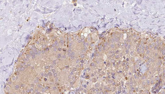 STX17 / Syntaxin 17 Antibody - 1:100 staining human thyroid carcinoma tissue by IHC-P. The sample was formaldehyde fixed and a heat mediated antigen retrieval step in citrate buffer was performed. The sample was then blocked and incubated with the antibody for 1.5 hours at 22°C. An HRP conjugated goat anti-rabbit antibody was used as the secondary.