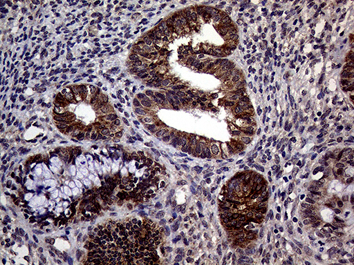 STX18 / Syntaxin 18 Antibody - Immunohistochemical staining of paraffin-embedded Adenocarcinoma of Human endometrium tissue using anti-STX18 mouse monoclonal antibody. (Heat-induced epitope retrieval by 1mM EDTA in 10mM Tris buffer. (pH8.5) at 120°C for 3 min. (1:2000)