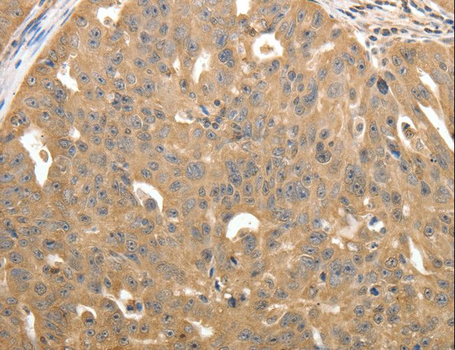 STX1A / Syntaxin 1A Antibody - Immunohistochemistry of paraffin-embedded Human ovarian cancer using STX1A Polyclonal Antibody at dilution of 1:40.