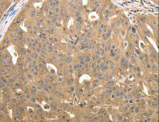 STX1A / Syntaxin 1A Antibody - Immunohistochemistry of paraffin-embedded Human ovarian cancer using STX1A Polyclonal Antibody at dilution of 1:40.
