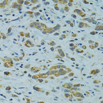 STX1A / Syntaxin 1A Antibody - Immunohistochemistry of paraffin-embedded human gastric cancer using STX1A antibody at dilution of 1:100 (40x lens).