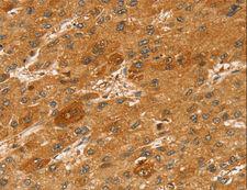 STX2 / Syntaxin 2 Antibody - Immunohistochemistry of paraffin-embedded Human liver cancer using STX2 Polyclonal Antibody at dilution of 1:50.