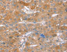 STX2 / Syntaxin 2 Antibody - Immunohistochemistry of paraffin-embedded Human liver cancer using STX2 Polyclonal Antibody at dilution of 1:40.