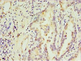 STX3 / Syntaxin 3 Antibody - Immunohistochemistry of paraffin-embedded human lung cancer using antibody at 1:100 dilution.