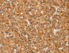STX3 / Syntaxin 3 Antibody - Immunohistochemistry of paraffin-embedded Human liver cancer using STX3 Polyclonal Antibody at dilution of 1:35.