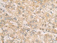 STX5 / Syntaxin 5 Antibody - Immunohistochemistry of paraffin-embedded Human liver cancer tissue  using STX5 Polyclonal Antibody at dilution of 1:70(×200)