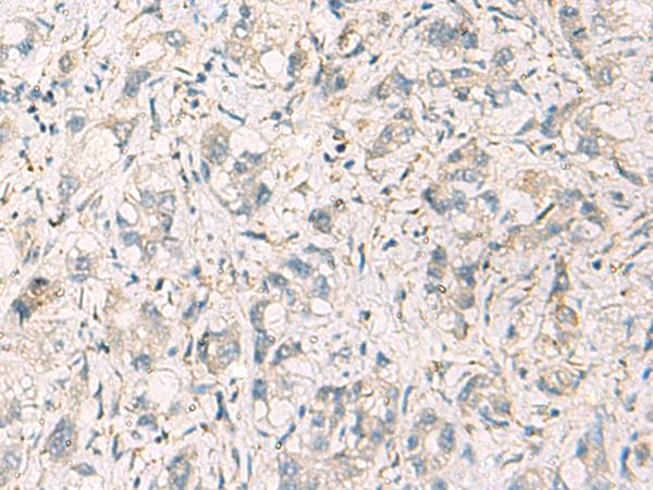 STX6 / Syntaxin 6 Antibody - Immunohistochemistry of paraffin-embedded Human liver cancer tissue  using STX6 Polyclonal Antibody at dilution of 1:60(×200)
