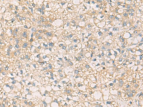 STX6 / Syntaxin 6 Antibody - Immunohistochemistry of paraffin-embedded Human liver cancer tissue  using STX6 Polyclonal Antibody at dilution of 1:45(×200)