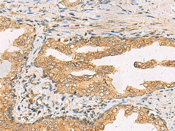 STX6 / Syntaxin 6 Antibody - Immunohistochemistry of paraffin-embedded Human prost ate cancer tissue  using STX6 Polyclonal Antibody at dilution of 1:45(×200)