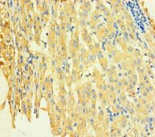 STX8 / Syntaxin 8 Antibody - Immunohistochemistry of paraffin-embedded human liver cancer using STX8 Antibody at dilution of 1:100