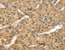 STX8 / Syntaxin 8 Antibody - Immunohistochemistry of paraffin-embedded Human breast cancer using STX8 Polyclonal Antibody at dilution of 1:45.