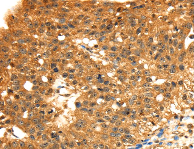 STX8 / Syntaxin 8 Antibody - Immunohistochemistry of paraffin-embedded Human breast cancer using STX8 Polyclonal Antibody at dilution of 1:45.