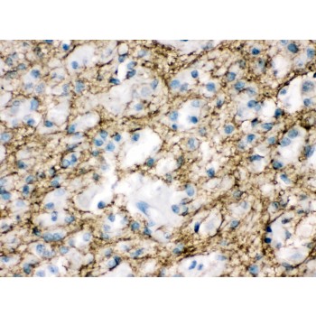 STXBP1 / MUNC18-1 Antibody - Munc18-1 antibody IHC-paraffin. IHC(P): Human Glioma Tissue.