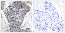 STXBP1 / MUNC18-1 Antibody - Peptide - + Immunohistochemistry analysis of paraffin-embedded human breast carcinoma tissue using MUNC-18a antibody.
