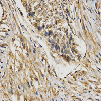 STXBP1 / MUNC18-1 Antibody - Immunohistochemistry of paraffin-embedded human esophageal cancer tissue.