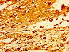 STXBP1 / MUNC18-1 Antibody - Immunohistochemistry image of paraffin-embedded human melanoma cancer at a dilution of 1:100