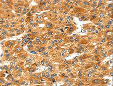 STXBP4 Antibody - Immunohistochemistry of paraffin-embedded Human liver cancer using STXBP4 Polyclonal Antibody at dilution of 1:40.