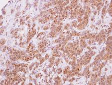 STYXL1 Antibody - IHC of paraffin-embedded Breast ca, using STYXL1 antibody at 1:500 dilution.