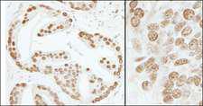 SUB1 Antibody - Detection of Human and Mouse PC4 by Immunohistochemistry. Sample: FFPE section of human prostate carcinoma (left) and mouse teratoma (right). Antibody: Affinity purified rabbit anti-PC4 used at a dilution of 1:200 (1 ug/ml) and 1:1000 (0.2 ug/ml). Detection: DAB.