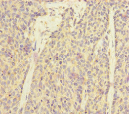SUCLA2 Antibody - Immunohistochemistry of paraffin-embedded human ovarian cancer at dilution of 1:100