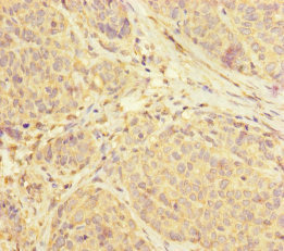 SUCLA2 Antibody - Immunohistochemistry of paraffin-embedded human ovarian cancer at dilution of 1:100