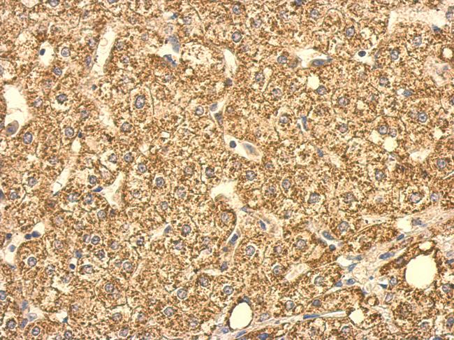 SUCLG2 Antibody - SUCLG2 antibody detects SUCLG2 protein at cytosol on hepatoma by immunohistochemical analysis. Sample: Paraffin-embedded hepatoma. SUCLG2 antibody dilution:1:500.