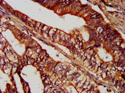 SUCLG2 Antibody - Immunohistochemistry image at a dilution of 1:300 and staining in paraffin-embedded human colon cancer performed on a Leica BondTM system. After dewaxing and hydration, antigen retrieval was mediated by high pressure in a citrate buffer (pH 6.0) . Section was blocked with 10% normal goat serum 30min at RT. Then primary antibody (1% BSA) was incubated at 4 °C overnight. The primary is detected by a biotinylated secondary antibody and visualized using an HRP conjugated SP system.