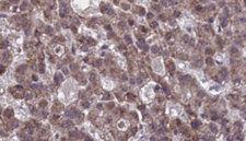 SUCNR1 / GPR91 Antibody - 1:100 staining human liver carcinoma tissues by IHC-P. The sample was formaldehyde fixed and a heat mediated antigen retrieval step in citrate buffer was performed. The sample was then blocked and incubated with the antibody for 1.5 hours at 22°C. An HRP conjugated goat anti-rabbit antibody was used as the secondary.