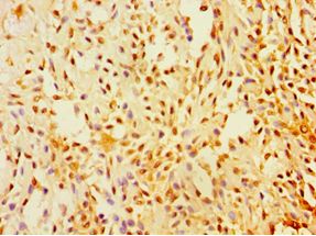 SUGCT / C7orf10 Antibody - Immunohistochemistry of paraffin-embedded human breast cancer using antibody at 1:100 dilution.