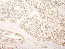 SUGP2 / SFRS14 Antibody - Detection of Human SFRS14 by Immunohistochemistry. Sample: FFPE section of human prostate carcinoma. Antibody: Affinity purified rabbit anti-SFRS14 used at a dilution of 1:250.