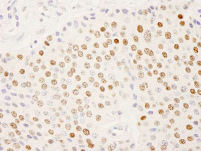 SUGP2 / SFRS14 Antibody - Detection of Human SFRS14 by Immunohistochemistry. Sample: FFPE section of human pancreatic islet cell tumor. Antibody: Affinity purified rabbit anti-SFRS14 used at a dilution of 1:250.